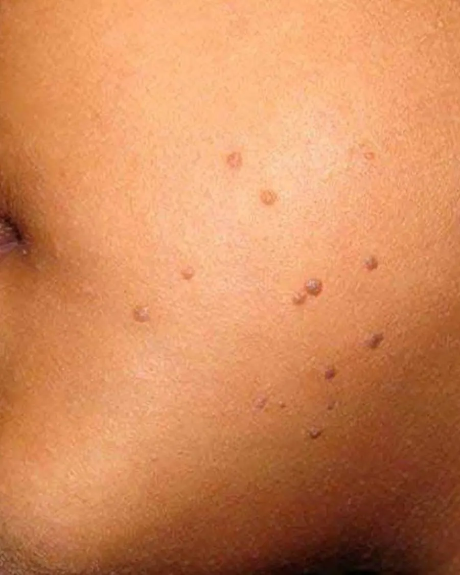 Advanced Dermatological Removal Techniques at Cinch Clinics